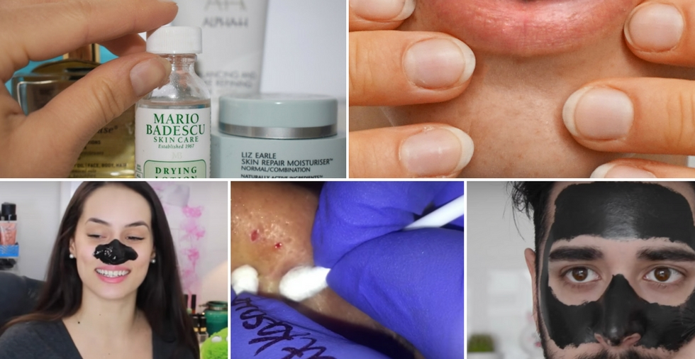 How To Get Rid Of Blackheads - FOR GOOD!