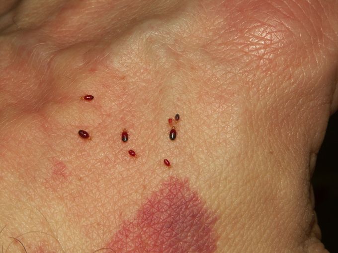 signs of bed bugs bites