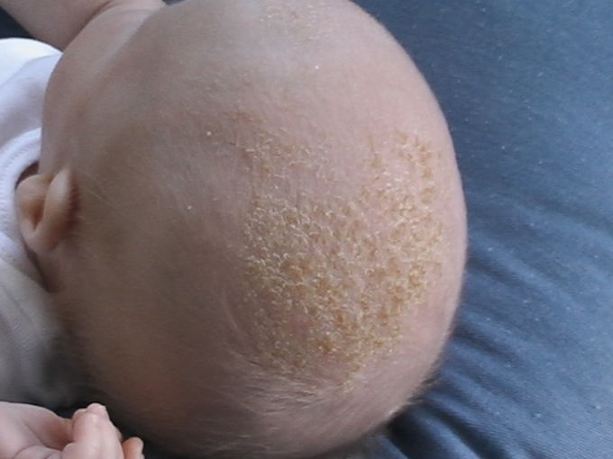 baby cradle cap