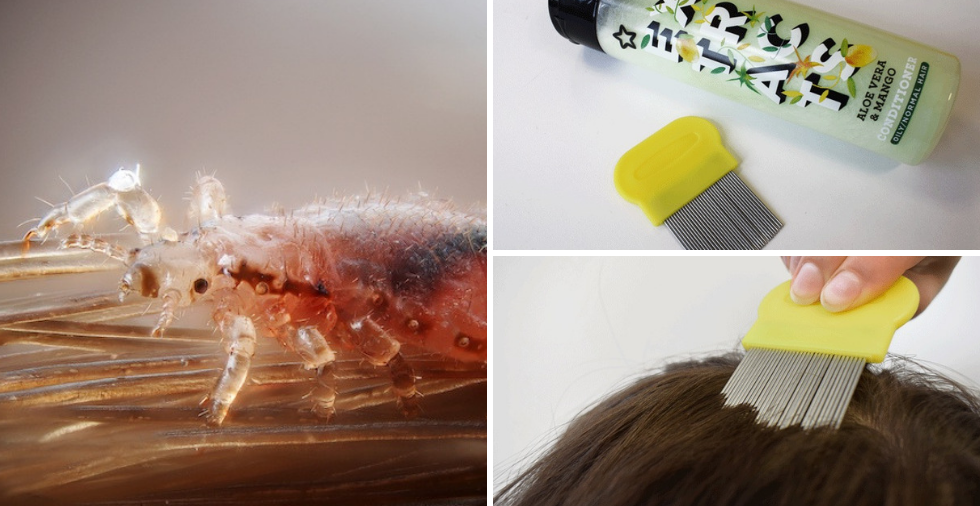 How To Get Rid Of Nits (Head Lice Treatments That ACTUALLY Work!)  