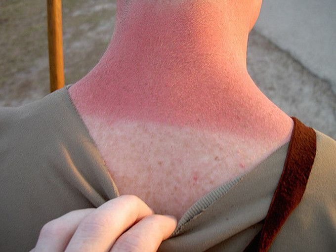 burnt neck