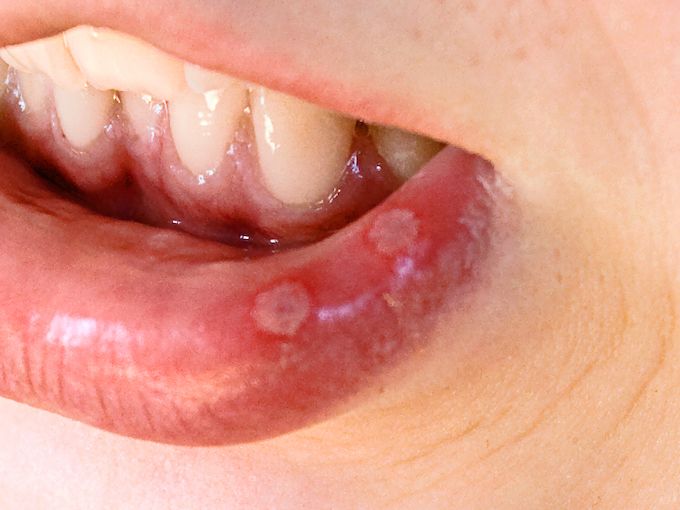 ulcers on botto lip]