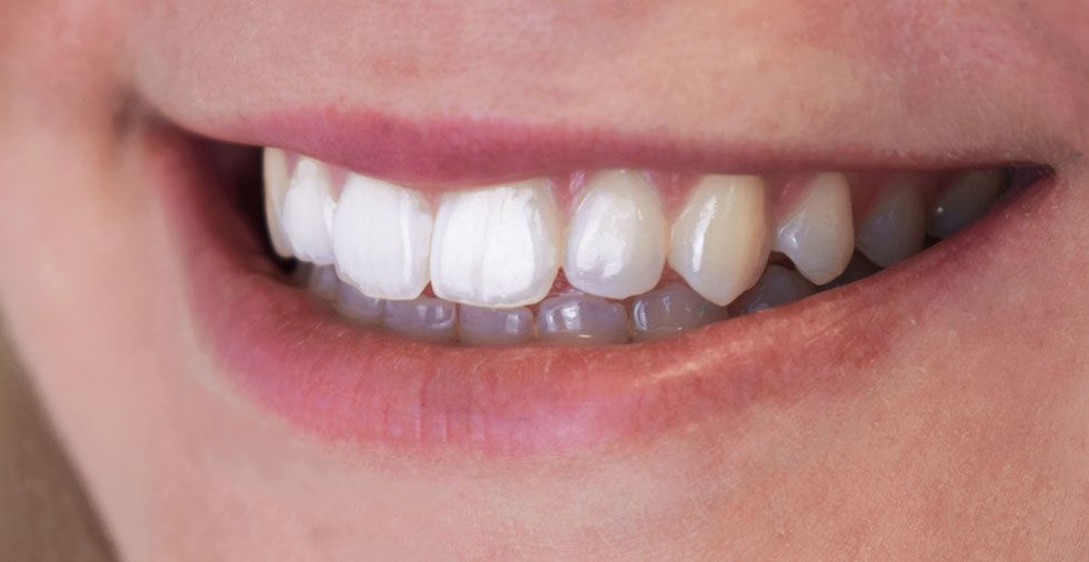 23 Surprising Ways To Whiten Your Teeth… & KEEP Them White